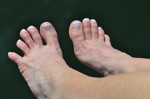 Callus on side of big toe