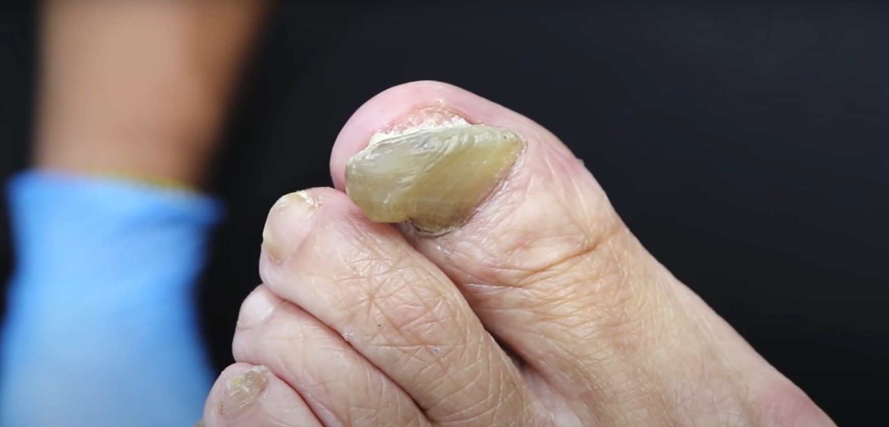 What Causes Thick Toenails