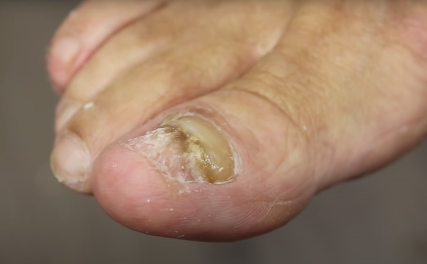 What Causes Thick Toenails