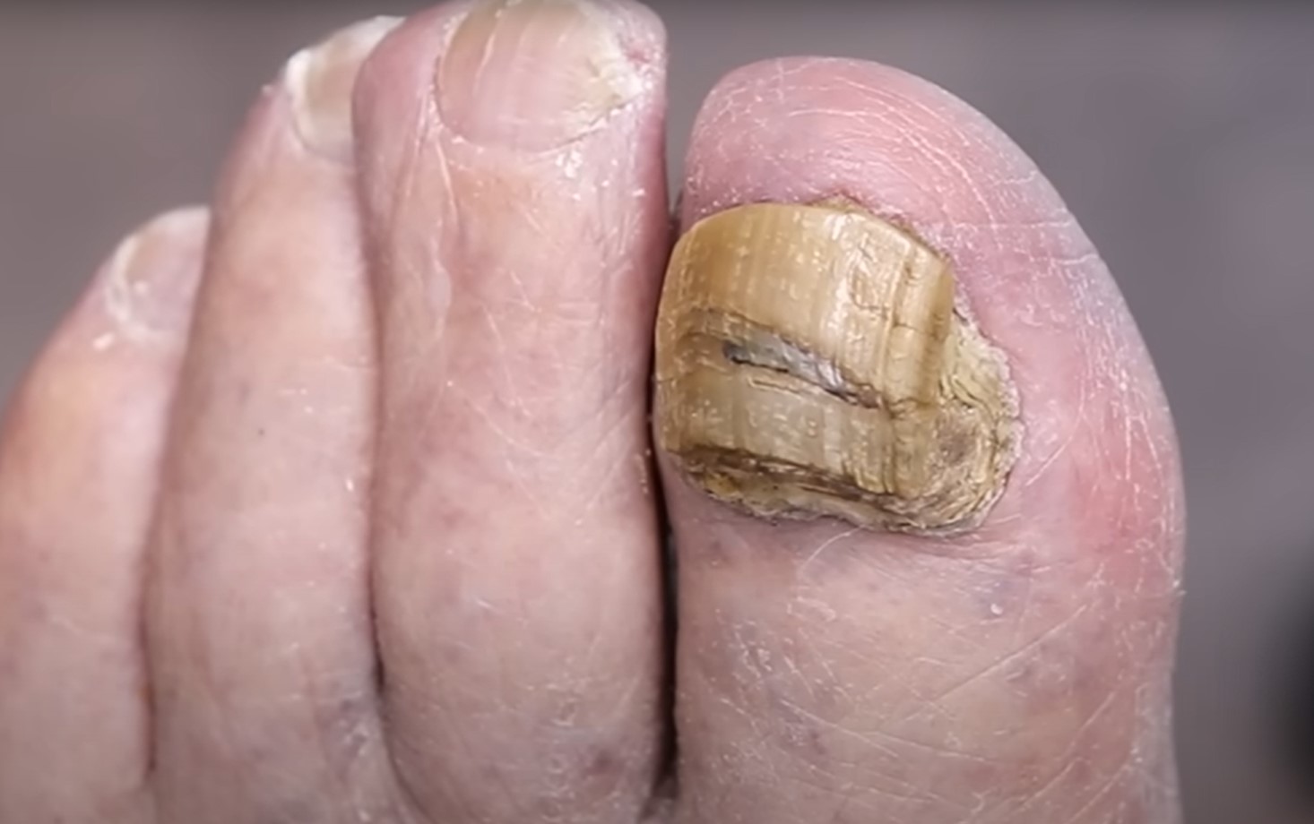 What Causes Thick Toenails
