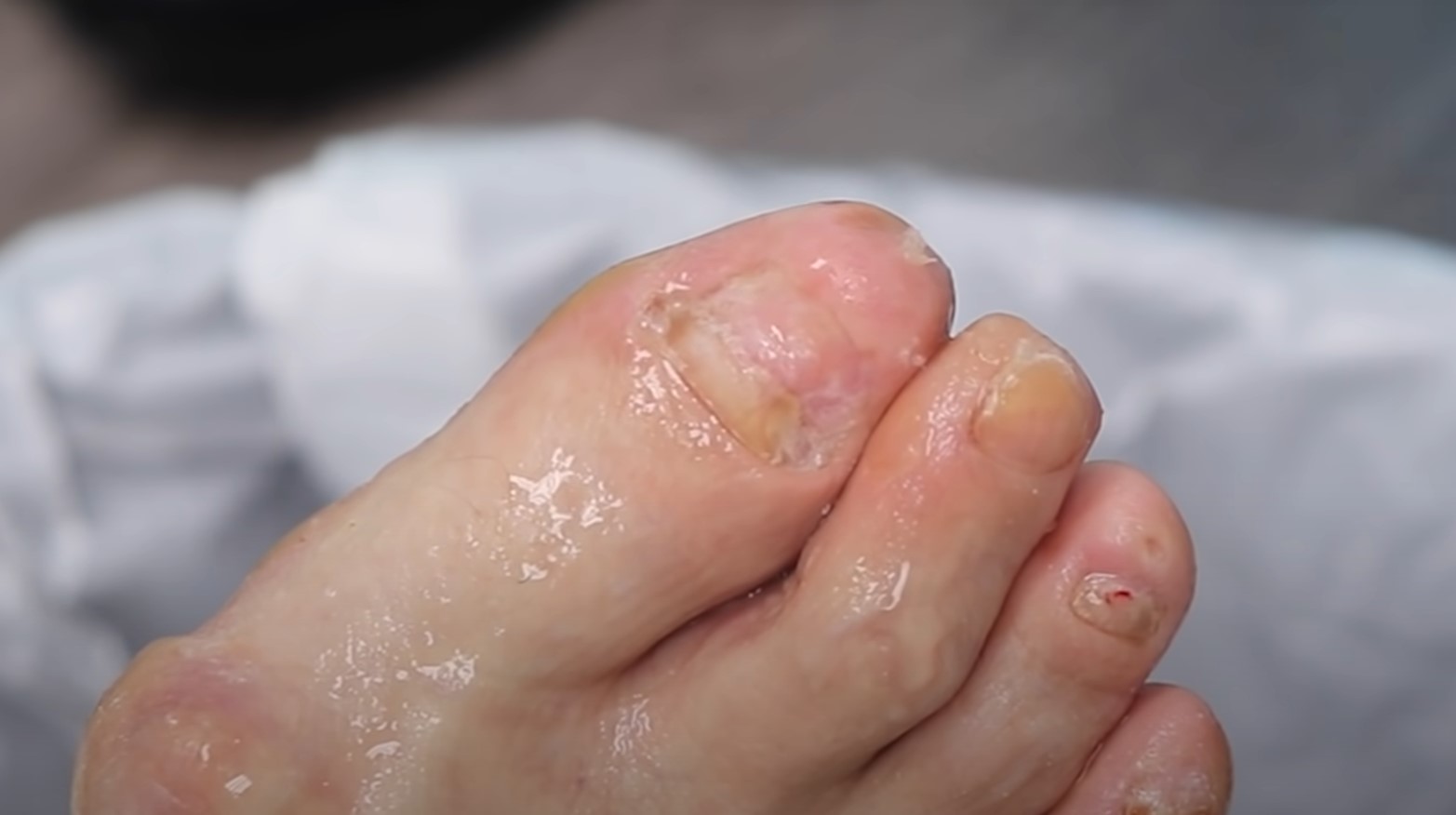 What Causes Thick Toenails