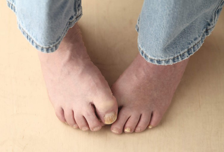 Home Remedies for Toenail Fungus