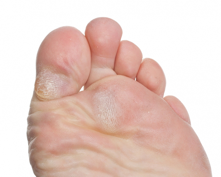How to Prevent Calluses on Feet 