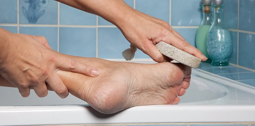 How to Prevent Calluses on Feet 