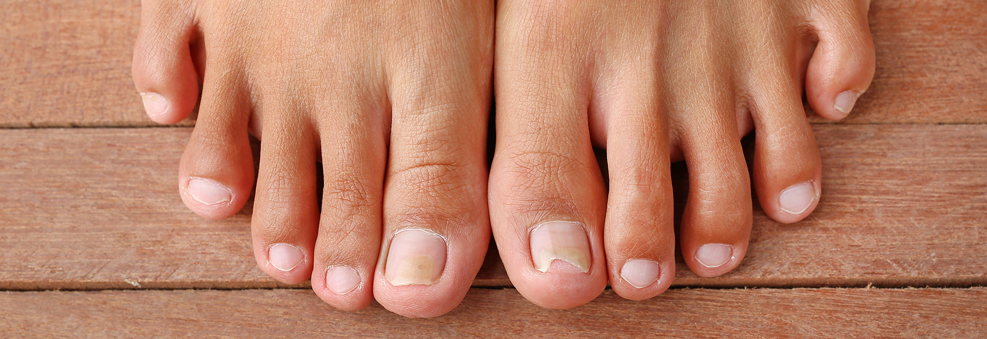 How to know if Toenail Fungus is Dying 