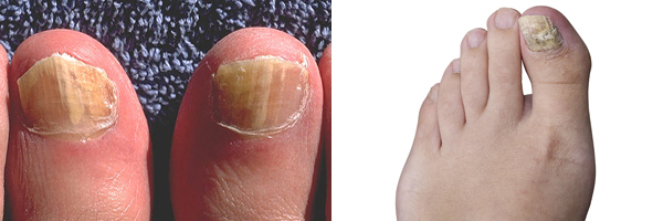 How to know if Toenail Fungus is Dying 