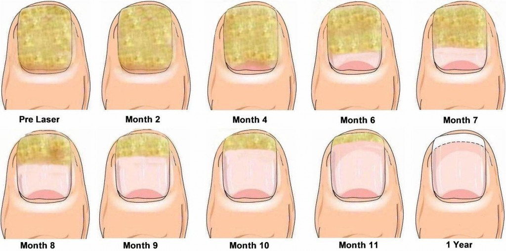 How to know if Toenail Fungus is Dying 