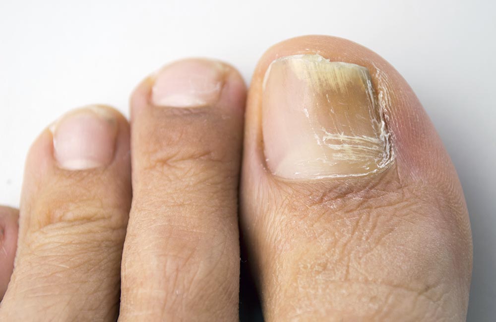 How to know if Toenail Fungus is Dying 