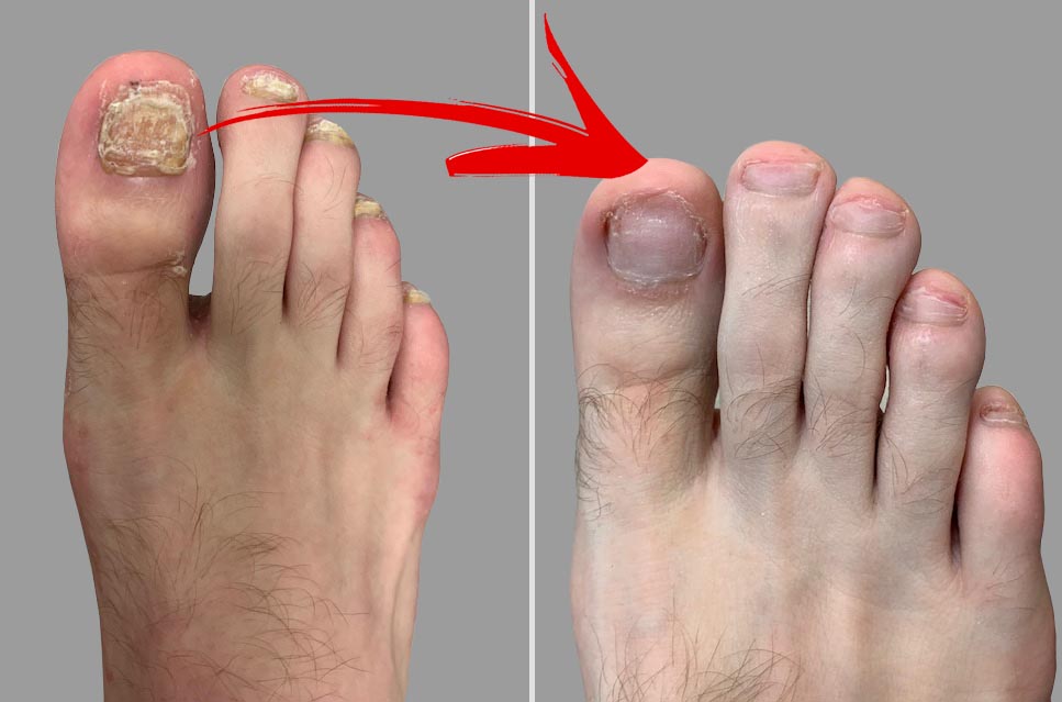 How to know if Toenail Fungus is Dying 