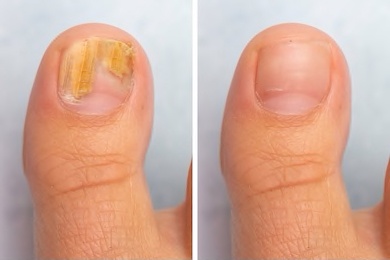 How to know if Toenail Fungus is Dying 