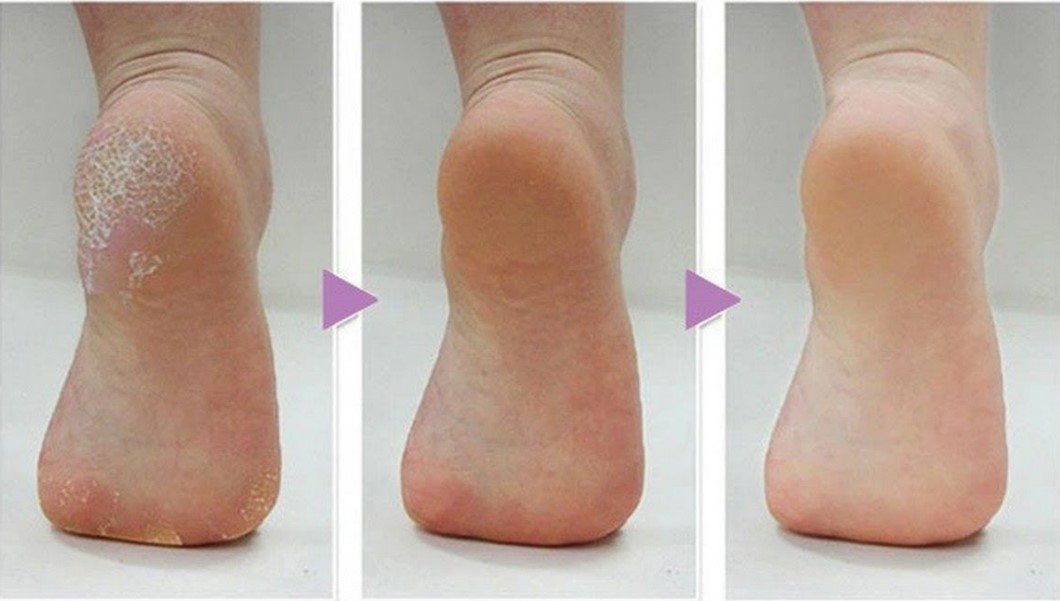 Prevent Calluses on Feet