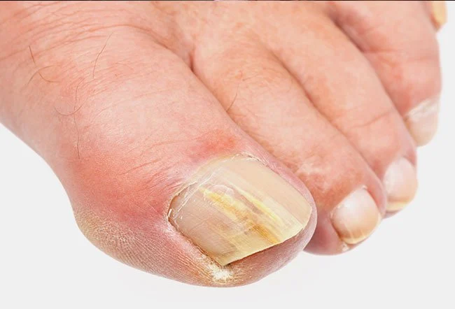 What Causes Thick toenails