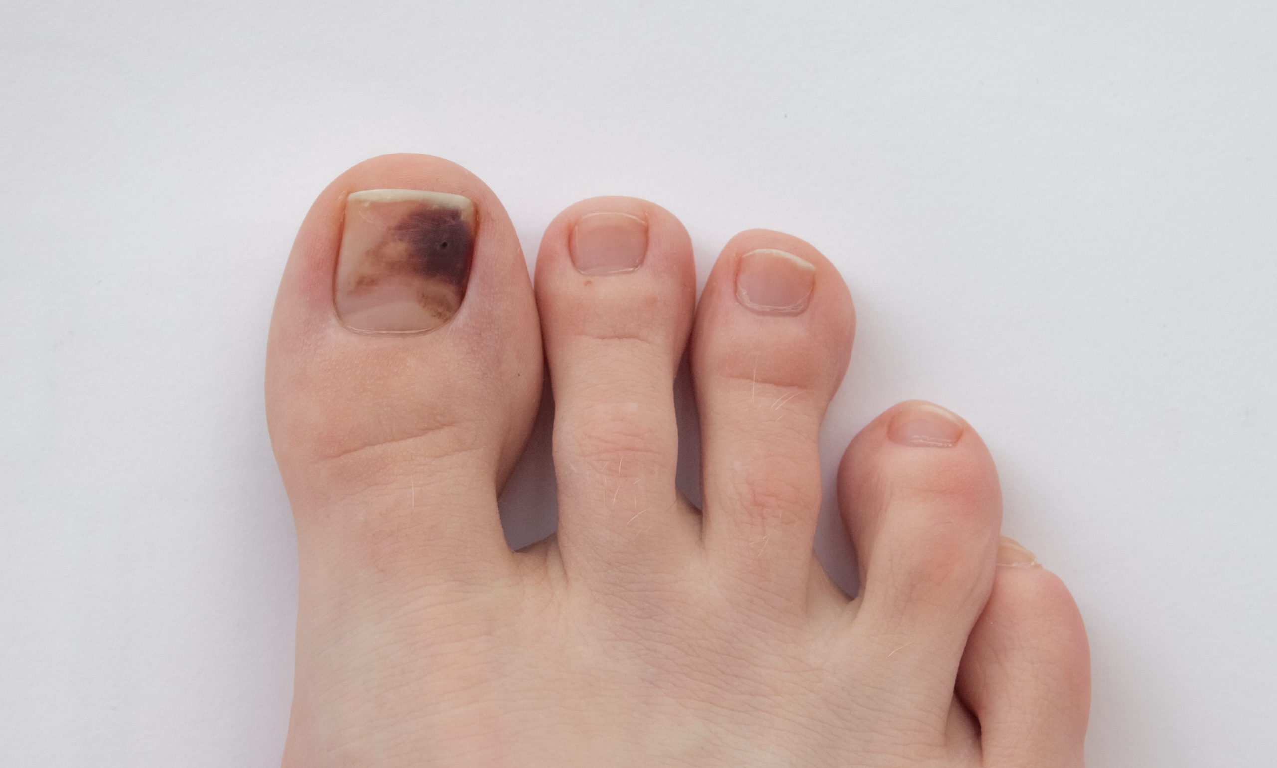 Why is My Toenail Black