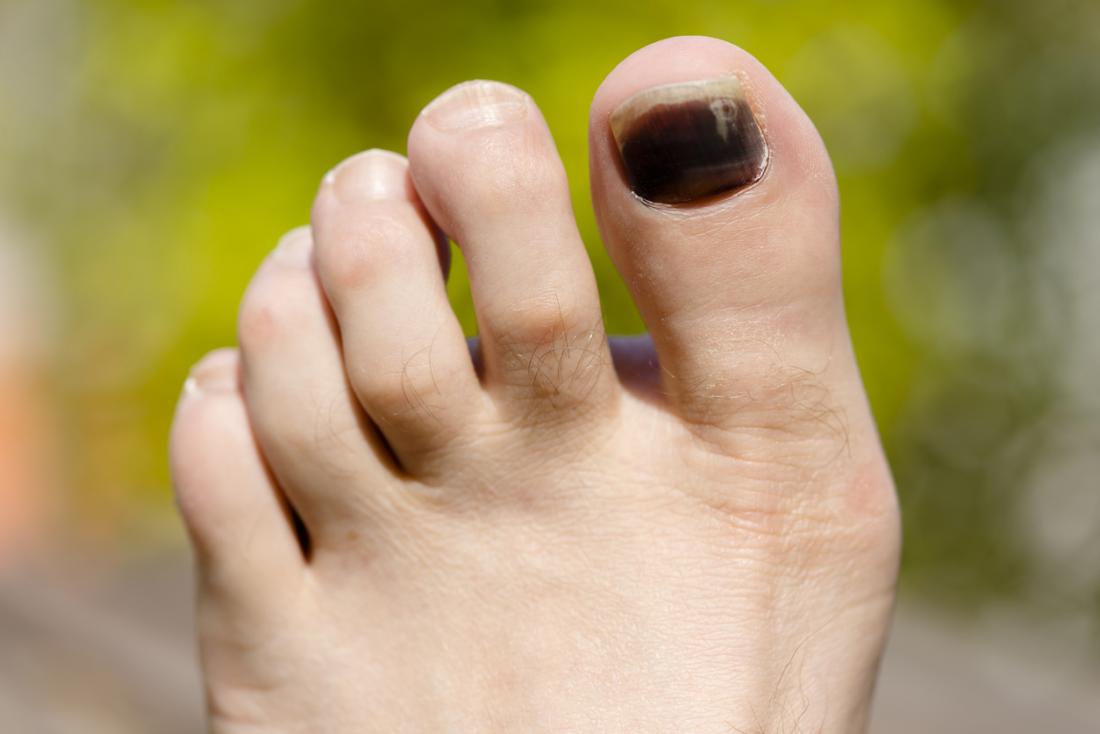 Why is My Toenail Black