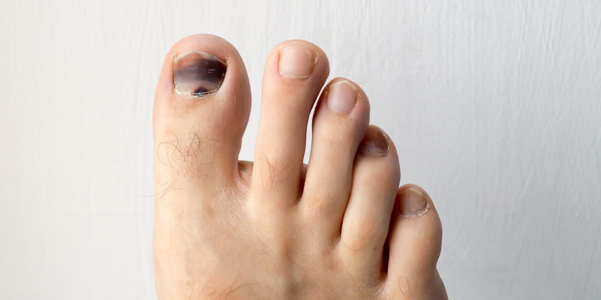 Why is My Toenail Black