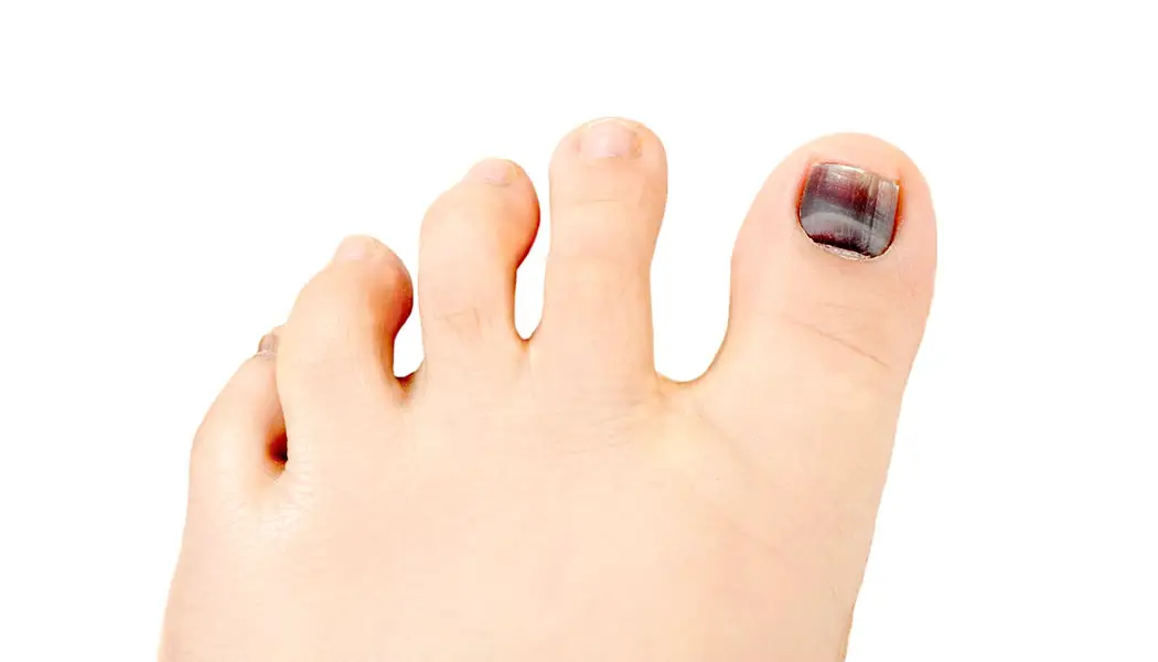 Why is My Toenail Black