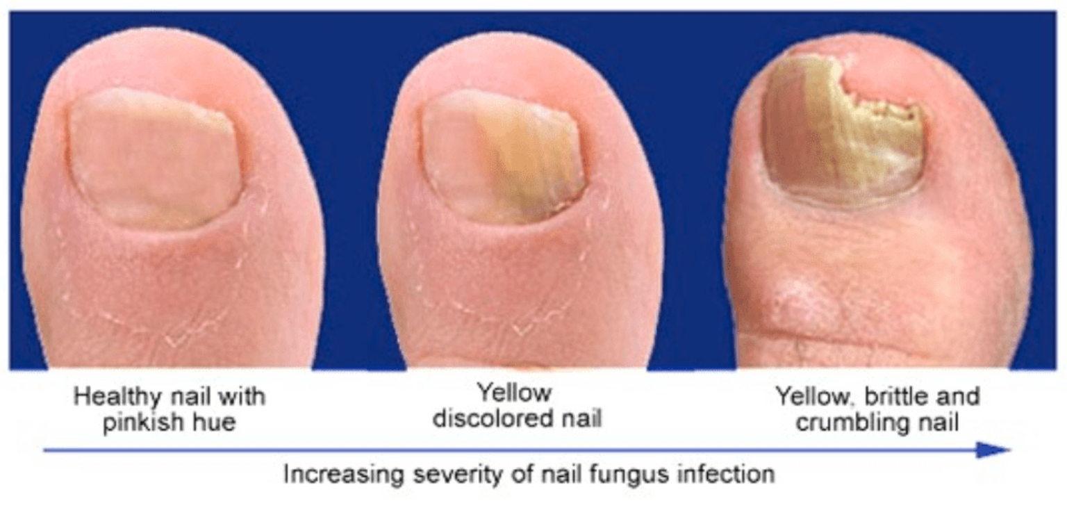 Is Toenail Fungus Contagious? Nail Clippers, Toenail Clippers and